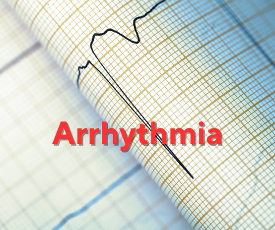 Arrhythmia: A Comprehensive Guide to Symptoms, Causes, Prevention, and Treatment